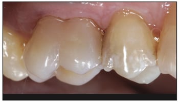 Watanabe Clinical GrandioSO Case Buccal After One Week