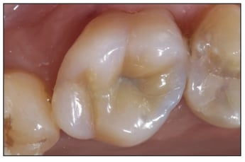 Watanabe Clinical GrandioSO Case Occlusal After One Week