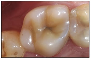 Watanabe Clinical GrandioSO Case Occlusal After Six Years